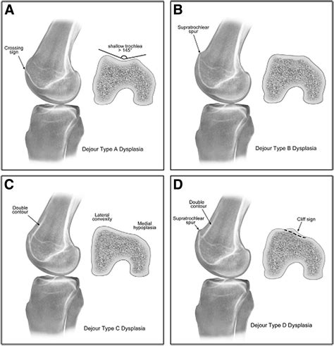 Patellofemoral Joint Reconstruction For Patellar Instability Medial