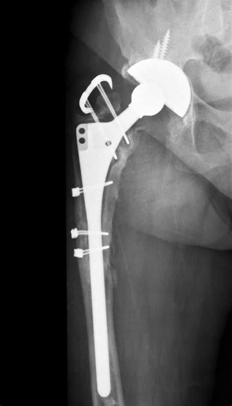Stryker Hip Replacement Lawsuits Law Offices Of Richard J Serpe Pc