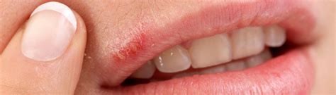 Cold Sores Causes Symptoms And Treatment Healthdirect