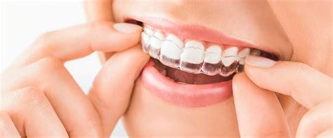 See full list on drarocha.com Invisalign 101 - How it Works, Pros & Cons, Cost - Maple ...