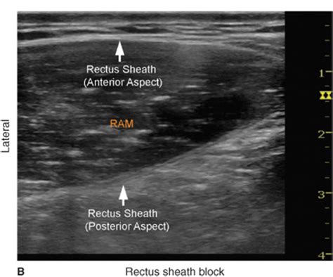 Ultrasound Guided Rectus Sheath Block Hadzics Peripheral Nerve