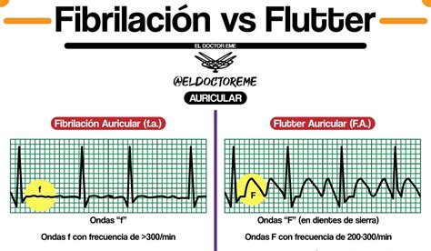 Ciencias Sentimental Arturo Flutter O Fibrilacion Auricular Sobrio