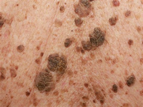 Seborrheic Keratosis Condition Treatments And Pictures For Adults Sexiz Pix