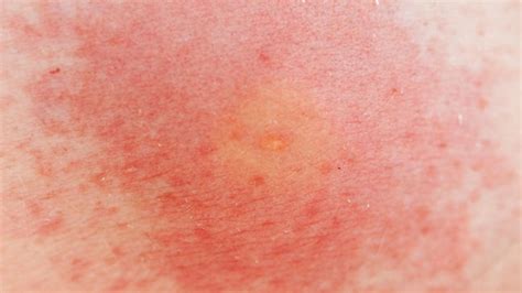 Wasp Sting Reaction Symptoms Treatments And Remedies