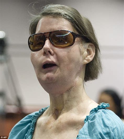 chimp attack settlement victim charla nash wins 4m compensation from owner daily mail online