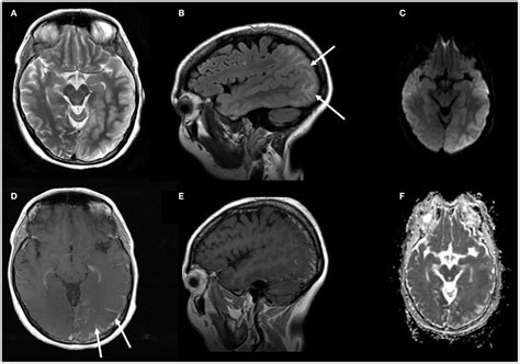 Frontiers A Case Of Posterior Reversible Encephalopathy Syndrome