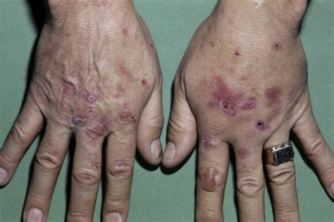 Hepatitis C Infection Cutaneous Manifestations Dermatology Advisor
