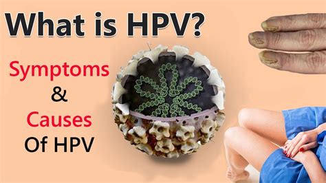 Human Papillomavirus Infection Symptoms Causes Of HPV YouTube