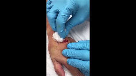 Ganglion Cyst Wrist Surgery