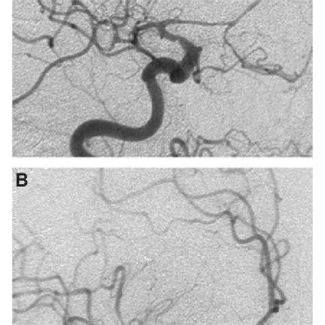 Aright Internal Carotid Artery Ica Angiogram Demonstrates