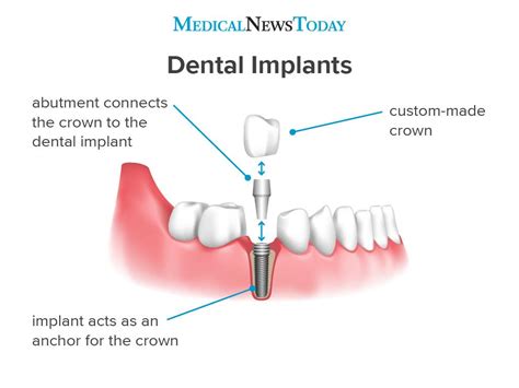 What Are Dental Implants Types Procedures And More