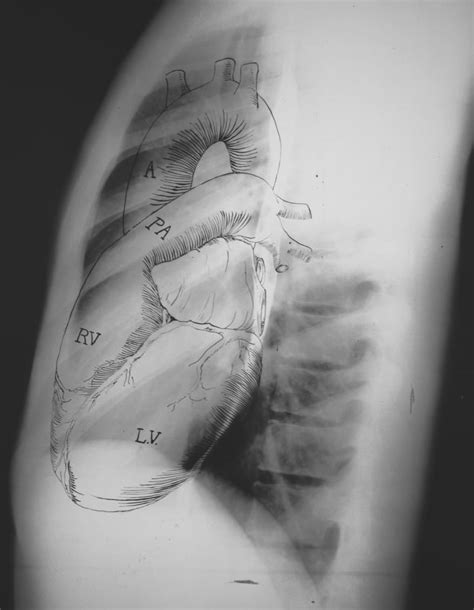 Lateral Chest X Ray Labeled