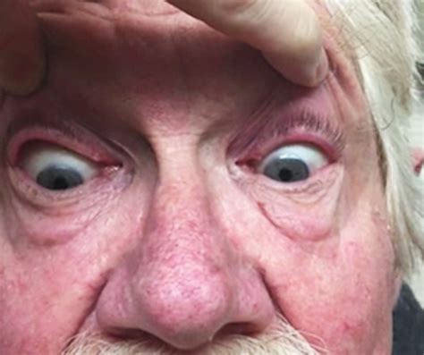 Opsoclonus Myoclonus Syndrome In 71 Year Old Patient