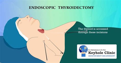 Endoscopic Thyroidectomy Thyroidectomy Thyroid Surgery Thyroid