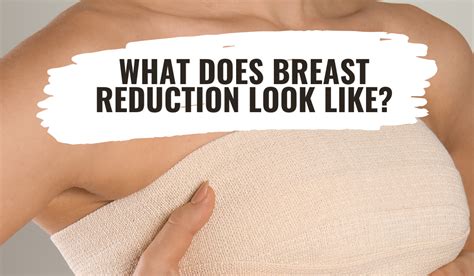 What Does A Breast Reduction Consultation Look Like