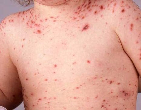 Das virus hat 2 gesichter: Wie sind die Symptome von Windpocken? | einWie.com