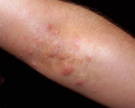 Herpes Zoster Or Shingles Symptoms And Treatment