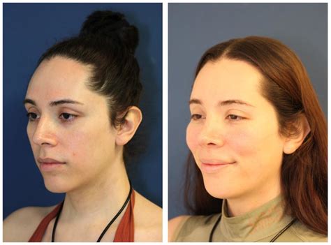 NYC Facial Feminization Before And After Pictures Upper East Side