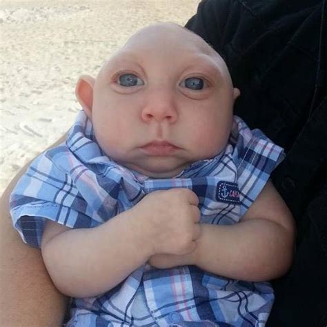 Us Baby Born With Half His Head Missing Defies Odds