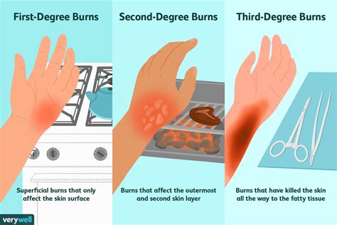 How To Cure Third Degree Burns Partskill