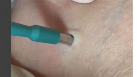 Watch You Wont Believe What Was Pulled From The Cyst In This Womans