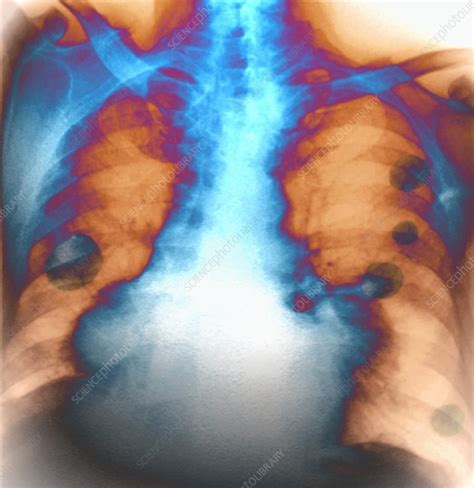 lung cancers x ray stock image m134 0482 science photo library