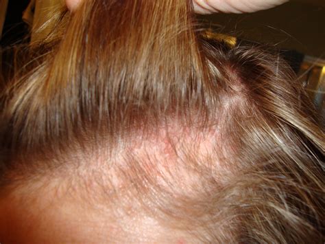 Itchy Sores On Scalp And Face Knot Under Skin After Pimple White