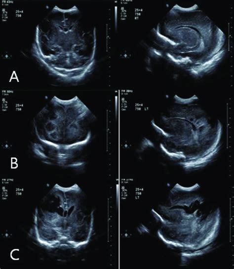 Ultrasonography Findings A Grade I Germinal Matrix Hemorrhage As