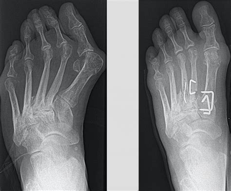 Pediatric Diseases And Treatment Pediatric Foot Deformities