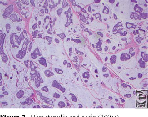 Figure 2 From Primary Mucinous Carcinoma Of The Skin Semantic Scholar