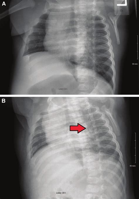 Healing Right Posterolateral Fourth Fifth And Sixth Rib Fractures