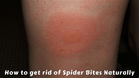 The first thing you should do if bitten is to try to identify the spider. How to get rid of Spider Bites Naturally