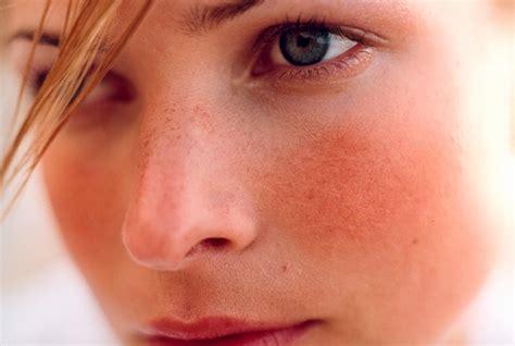 8 Natural Remedies For Rosacea How To Use Herbal Remedies For Rosacea