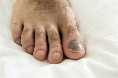 Blue Toe Syndrome Stock Photos Pictures And Royalty Free Images Istock