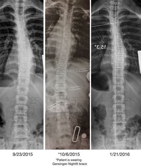 Spinal Braces Scoliosis Bracing Innovations