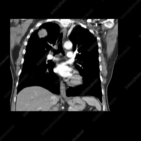 Lung Cancer Ct Stock Image C0034696 Science Photo Library