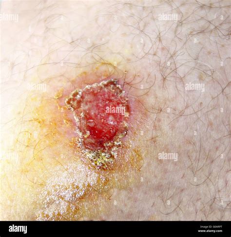 Scab Stock Photos And Scab Stock Images Page 2 Alamy