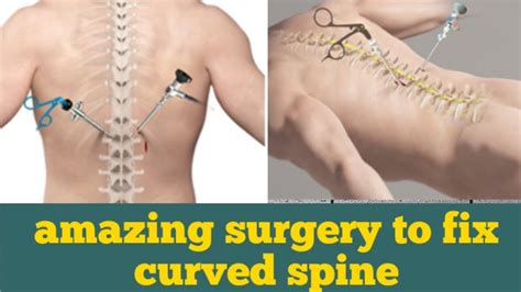amazing surgery to fix curved spine scoliosis animation youtube