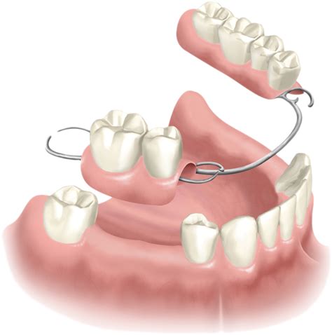 Partial Dentures Windsor Ct Removable Dentures