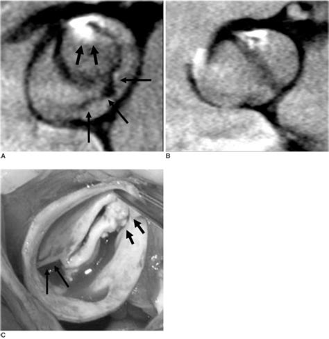Thickened Unicommisural Unicuspid Valve With Severe Aortic Stenosis