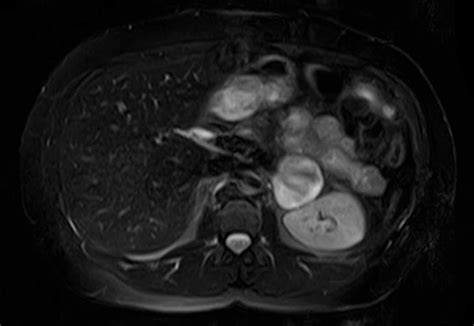 Adrenal Pheochromocytoma Body Mr Case Studies Ctisus Ct Scanning