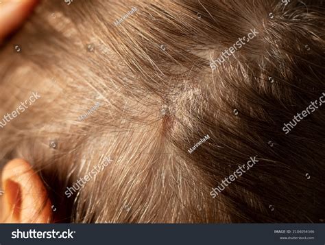 Dry Itchy Scalp Scabs On Womans Stock Photo 2104054346 Shutterstock