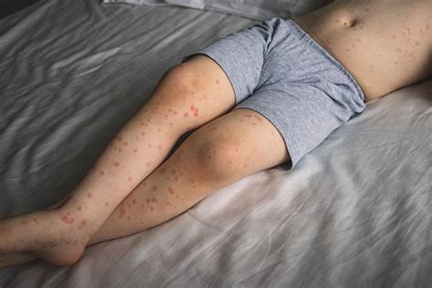 Viral Rash On Child Types Causes Treatment And Prevention