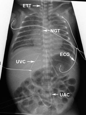 Umbilical vein catheterization - WikEM