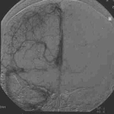 Thrombose eines venösen sinus oder einer hirnvene ät: MRI-Library: Sinusvenenthrombose