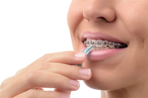 Prevent Tooth Enamel Problems During Braces With Proper Orthodontic Care Belmar Orthodontics