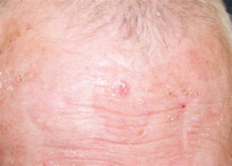Basal Cell Cancer Bcc Skin Repair