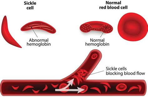 Sickle Cell Disease How Your Eye Doctor Can Help
