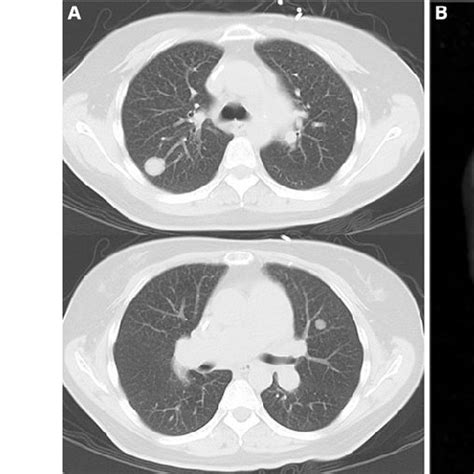 Chest Computed Tomography Showed Bilateral Pulmonary Nodules A And