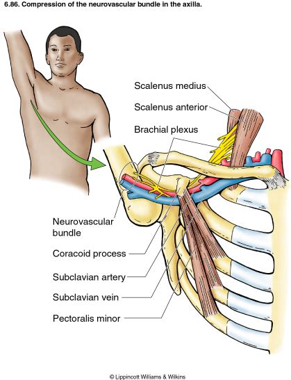 Thoracic Outlet Syndrome Symptoms Causes And Treatment